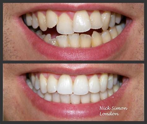 The Fairy Godmother of Dentistry: How Magical Teeth Braces Can Straighten Your Teeth